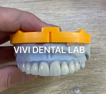 Ivoclar Emax Laminate Veneers Şeffaf Profesyonel Yüksek Seviye Çin Diş Laboratuarı