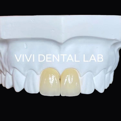 Doğal görünümlü dental laboratuvar taçları Ivoclar Estetik Zirkonya taçları