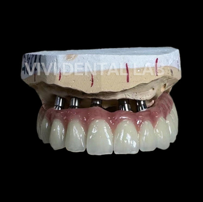 Total Implant PFM Bridge Çin Diş Laboratuarı