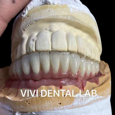 Diş implantı Titanyum abutment üzerine metal seramik köprü