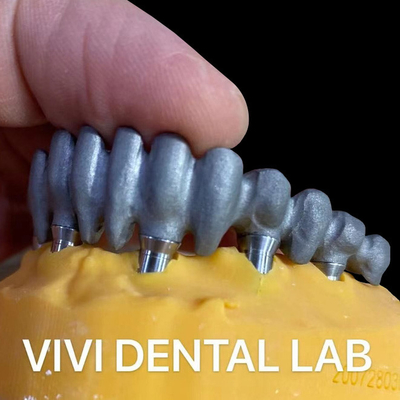 Çin Diş Laboratuvarı'ndan basılmış PFM Multi Unit Abutments Üzerine Köprü