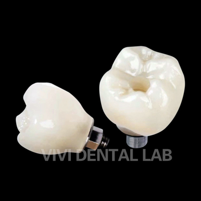 Dental implant kronu PFZ porselen katmanlı zirkonya