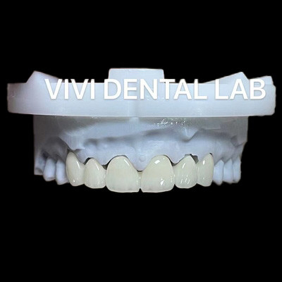 Dental Anterior Zirconia Köprüsü ISO Sertifikalı Hızlı Dönüş Zamanı