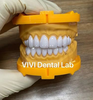 Ivoclar Emax Laminate Veneers Yüksek Şeffaflık Çin Diş Laboratuarı
