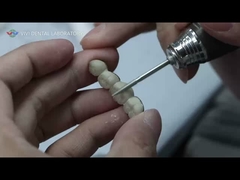 Metal Keramik Köprü